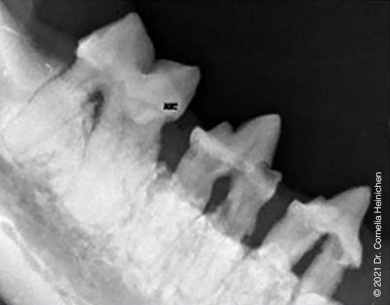 Horizontaler Knochenabbau des Unterkieferknochens mit deutlichen Umbauvorgängen im Zahnwurzelbereich