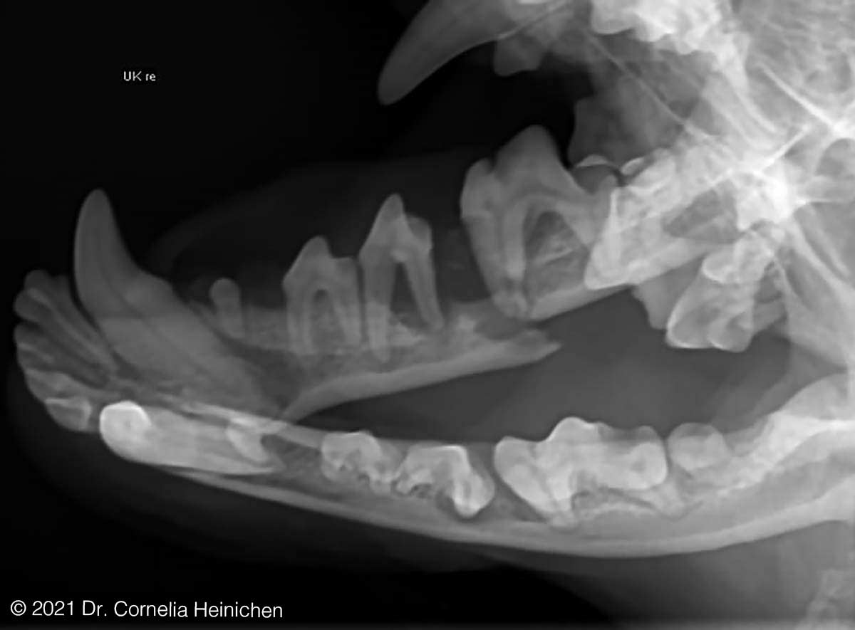 Spontanfraktur des Unterkiefers durch hochgradigen Knochenabbau infolge chronischer Parodontitis